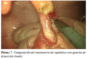 Apéndice con gancho de disección (hook) Apéndice con gancho de disección (hook)