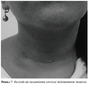 Incisión de vaciamiento cervical mínimamente invasivo