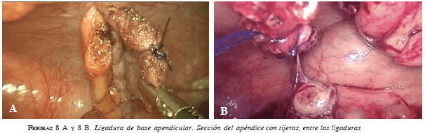 Ligadura de base apendicular Ligadura de base apendicular