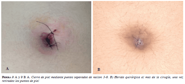 Muestra la herida quirúrgica un mes después Muestra la herida quirúrgica un mes después