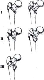 Clasificación de Evans-Jensen de las fracturas intertrocantéricas Clasificación de Evans-Jensen de las fracturas intertrocantéricas