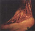 Corrección quirúrgica del PEVC Corrección quirúrgica del PEVC