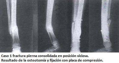 Fractura pierna consolidada en posición viciosa