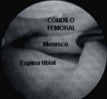 Menisco discoide interno - Condilo femoral