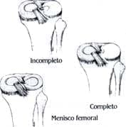 Menisco discoide lateral