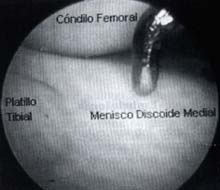 Menisco discoide interno