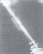 Fractura diafisaria y de cuello femoral ipsilateral