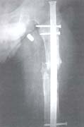 Fractura de fémur resultado con clavos Fractura de fémur resultado con clavos
