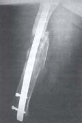Fractura de fémur resultado con placa e injertos óseos Fractura de fémur resultado con placa e injertos óseos