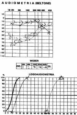Audiometría y logoaudiometría
