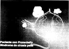 Paciente con Prune-belly Paciente con Prune-belly