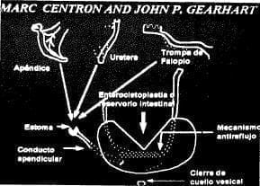 Procedimiento de mitrofanoff Procedimiento de mitrofanoff