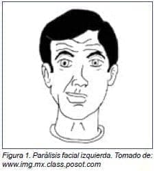 Parálisis facial izquierda Parálisis facial izquierda