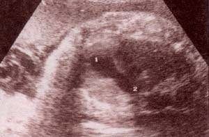 Diagnóstico Prenatal -  tractos de salida