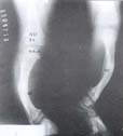 Seudoartrosis congénita de tibia tipo II de Boyd Seudoartrosis congénita de tibia tipo II de Boyd