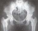 Radiografía de pelvis que muestra las lesiones Radiografía de pelvis que muestra las lesiones
