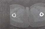 TAC femoral bilateral que muestra lesión quística TAC femoral bilateral que muestra lesión quística