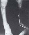 Seudoartrosis congénita de tibia tipo V de Boyd7 en niño Seudoartrosis congénita de tibia tipo V de Boyd7 en niño