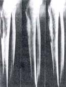 Forma osteolítica de la Eenfermedad de Paget Forma osteolítica de la Eenfermedad de Paget