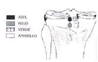 Técnica para reconstruir el ligamento cruzado posterior Técnica para reconstruir el ligamento cruzado posterior