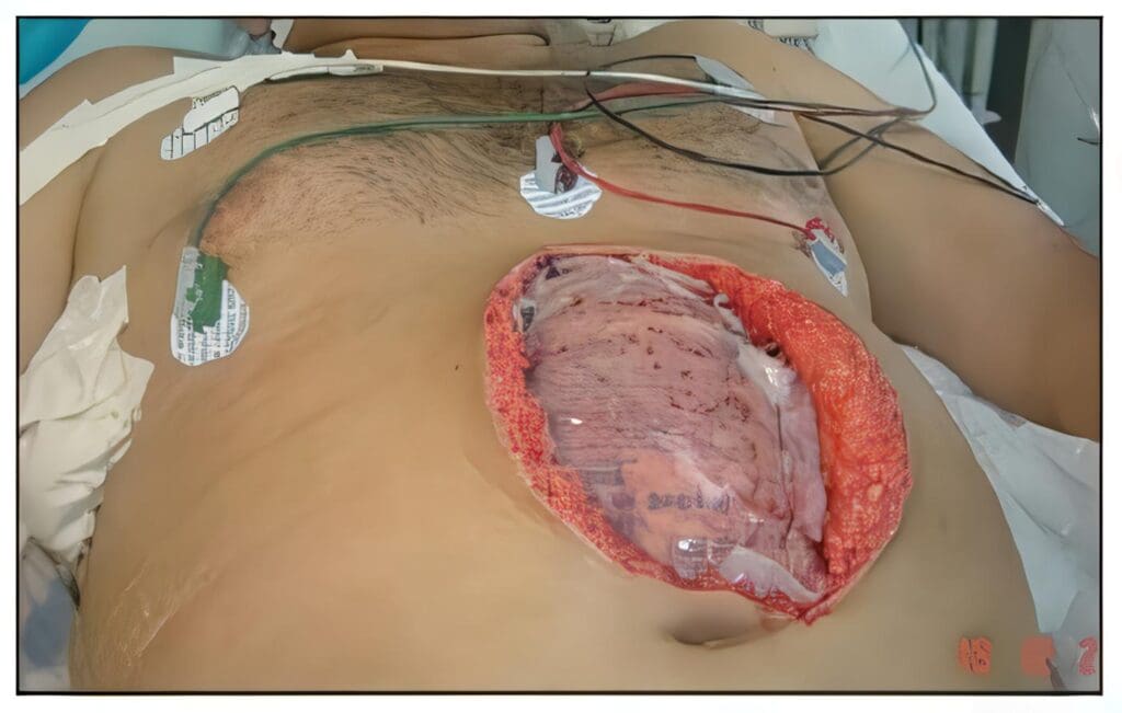 Uso de Malla en Abdomen Abierto