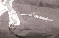 Prueba de Allen se palpa la arteria, Línea Arterial Periférica Prueba de Allen se palpa la arteria, Línea Arterial Periférica