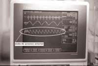Asegurar el catéter con esparadrapo, conectar en prueba de Allen Asegurar el catéter con esparadrapo, conectar en prueba de Allen