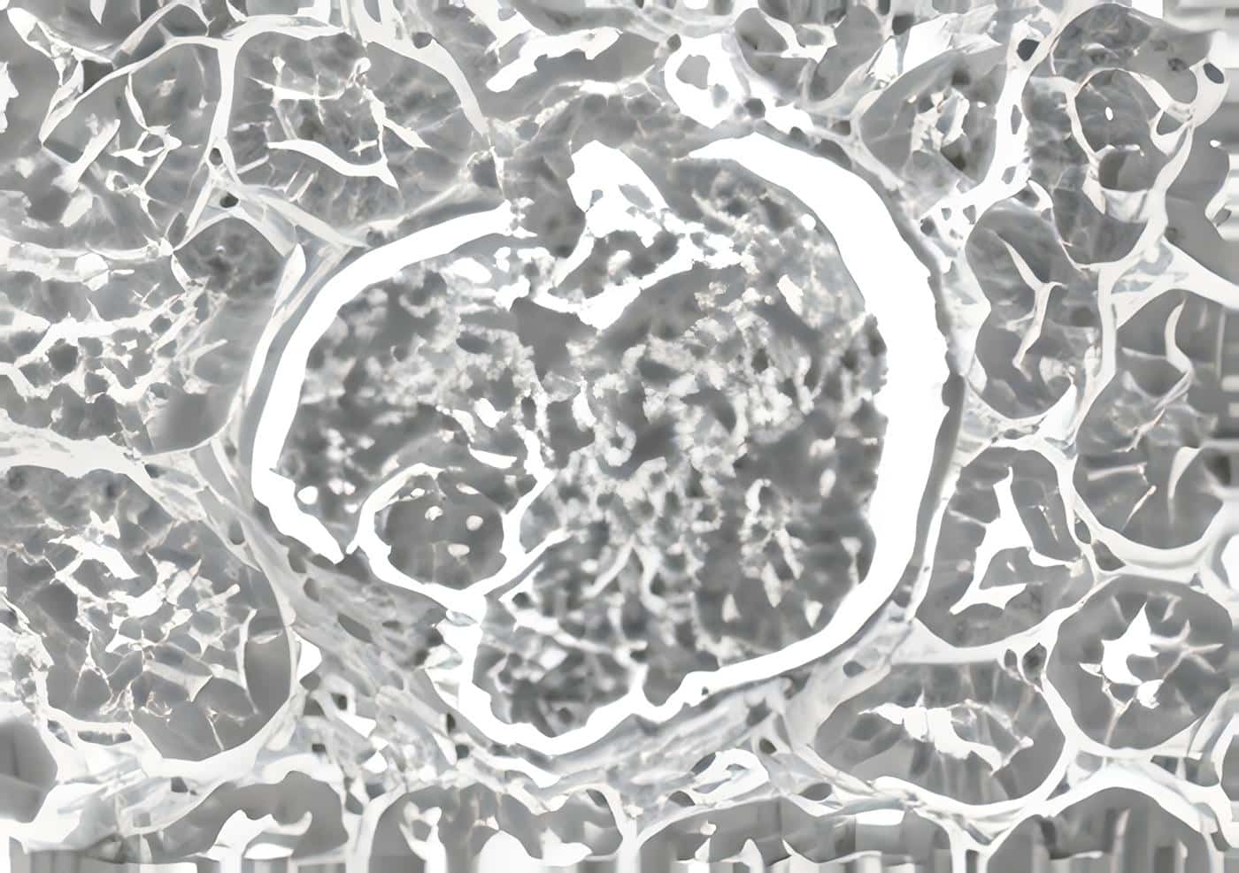 Patología en hipoplasia Renal
