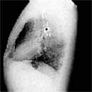 Experiencia clínica en el Diagnóstico de ALTE Experiencia clínica en el Diagnóstico de ALTE