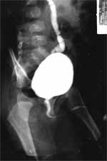 Cistografía en la displasia - hipoplasia Renal