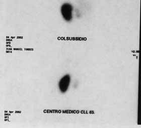 Gamagrafía Displasia