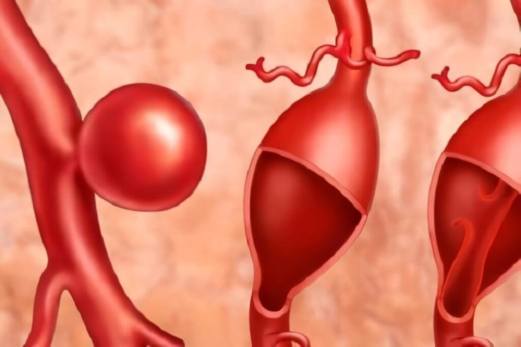 Reparación Endovascular de Aneurismas de Aorta Abdominal (Parte I): Limitaciones