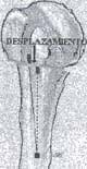 Desplazamiento residual - Fractura de Húmero Desplazamiento residual - Fractura de Húmero