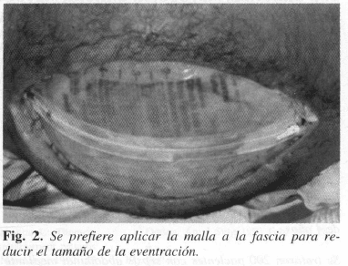 Malla a la fascia para reducir el tamaño de la eventración Malla a la fascia para reducir el tamaño de la eventración