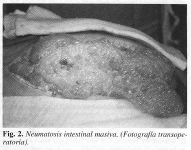 Neumatosis intestinal masiva Neumatosis intestinal masiva
