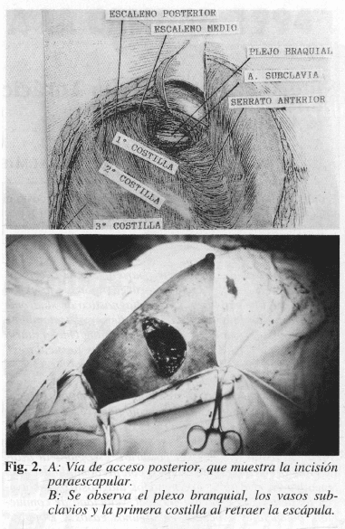 Incisión paraescapular