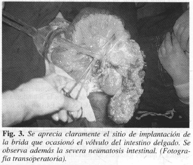 Vólvulo del intestino delgado Vólvulo del intestino delgado