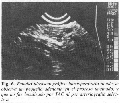 Estudio ultrasonográfico intraoperatorio se observa un pequeño adenoma  Estudio ultrasonográfico intraoperatorio se observa un pequeño adenoma
