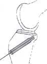 Técnica para reconstruir el LCP anclaje femoral del injerto  Técnica para reconstruir el LCP anclaje femoral del injerto