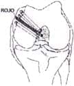 Artrotomía parapatelar interna - Ligamento cruzado posterior Artrotomía parapatelar interna - Ligamento cruzado posterior