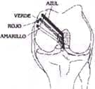 Artrotomía parapatelar interna - Ligamento cruzado posterior LCP Artrotomía parapatelar interna - Ligamento cruzado posterior LCP