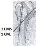 Inserción de los clavos - Fractura de Húmero Inserción de los clavos - Fractura de Húmero