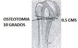 Osteotomía 10 grados - Fractura de Húmero Osteotomía 10 grados - Fractura de Húmero