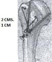 Inserción de los tornillos canulados - Fractura de Húmero Inserción de los tornillos canulados - Fractura de Húmero
