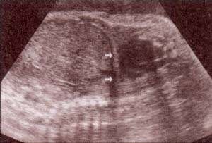 Tórax - longitudinales (a las 33 y 38 semanas)