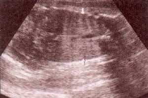 Tórax Normal - pulmones corte coronal. 32 semanas