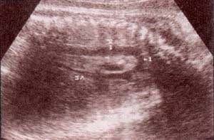 Diagnóstico Prenatal - vasos intratorácicos