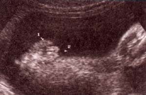 Diagnóstico Prenatal -  genitales externos xx