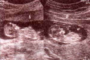 Diagnóstico Prenatal -  .gemelar monocorial - monoamniótico Diagnóstico Prenatal -  .gemelar monocorial - monoamniótico