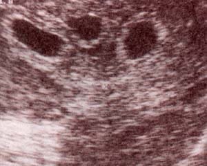 Embarazo múltiple Embarazo múltiple